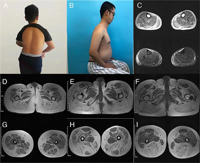 Delayed Respiratory Insufficiency and Extramuscular Abnormalities in Selenoprotein N-Related Myopathies